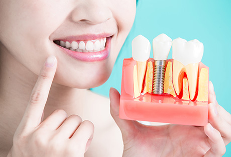 自分の歯ように咬めるようになるインプラント治療