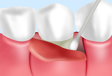 歯周外科手術